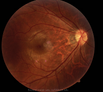 Automated identification of exudates and bleeding spots on color fundus photographs and ultrawide field retinal images