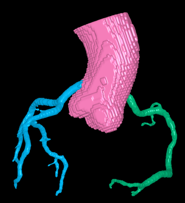 Lung Vessels (Arteries and Veins)
