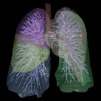 Chronic Obstructive Pulmonary Disease