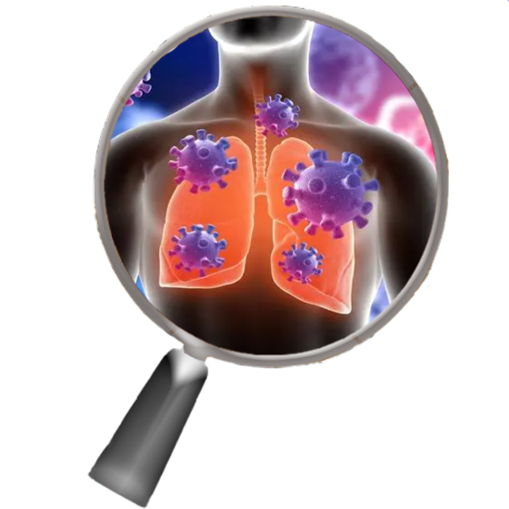 Pneumonia (covid-19)