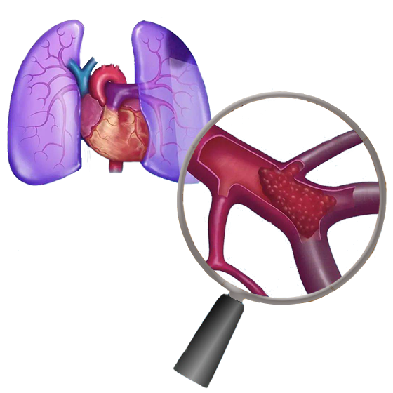 Automated Detection and Segmentation of PE regions on CTPA